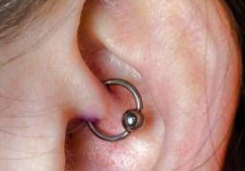 Daith piercings for migraines: Do they help and alternative treatments