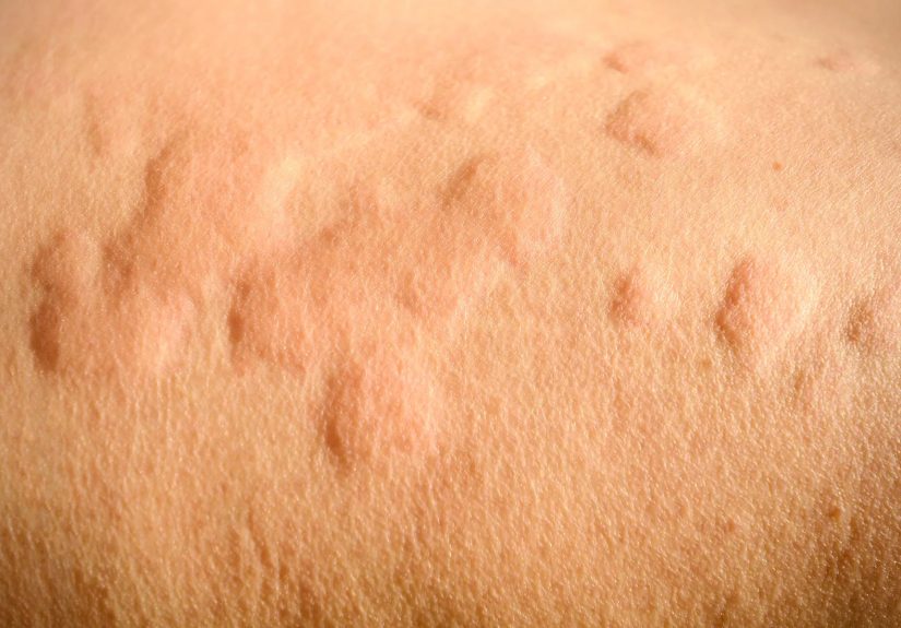Diagnóstico de la Urticaria Crónica Idiopática (Urticaria)