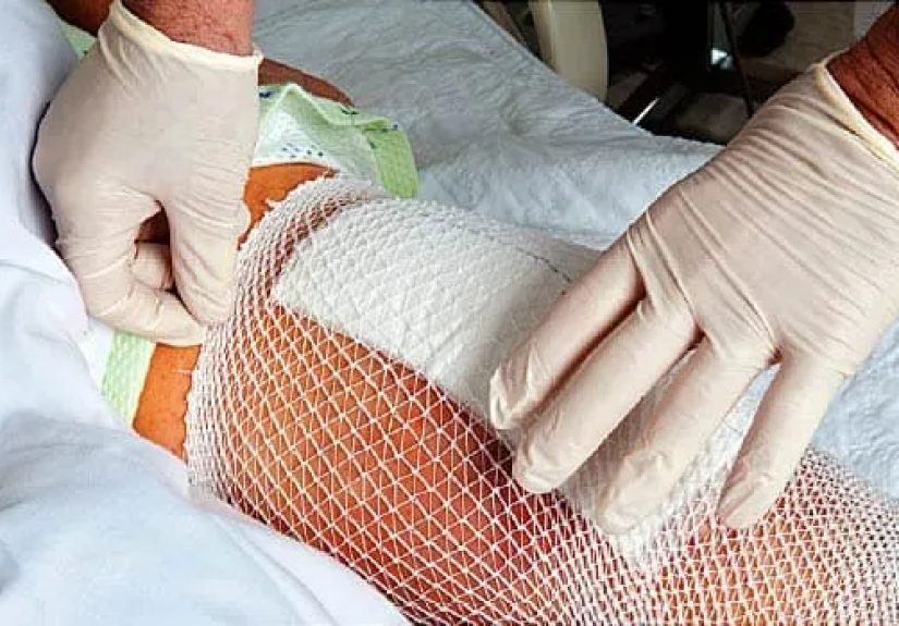 How to Take Care of Your Incision After Surgery