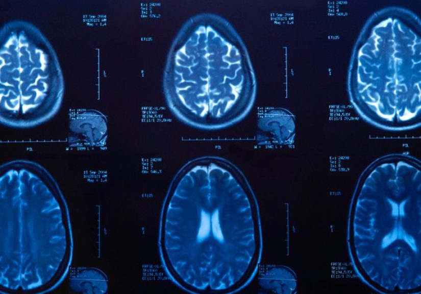 MRI scans for Parkinson's disease: Results and other tests