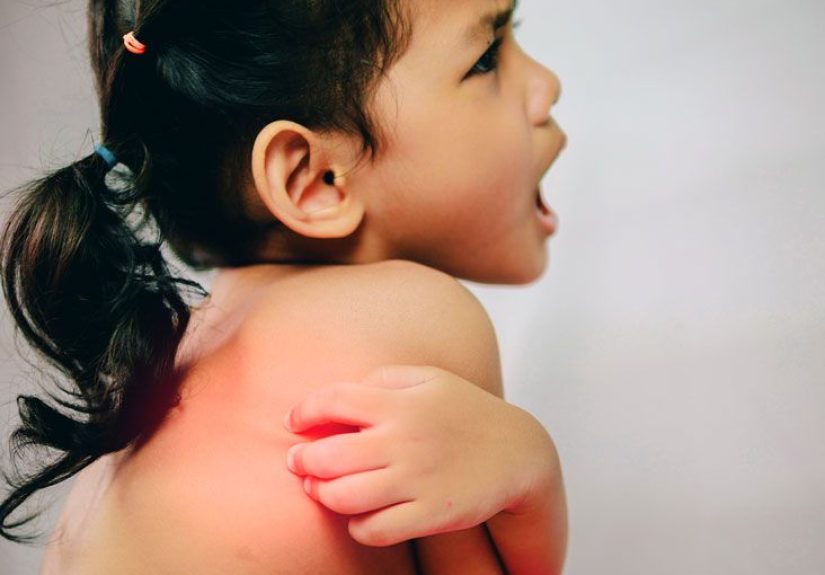 Pityriasis Alba: Causes, Symptoms, and Treatments