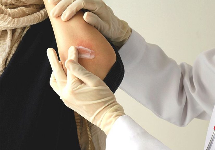 Psoriasis: What’s the Genetic Link?