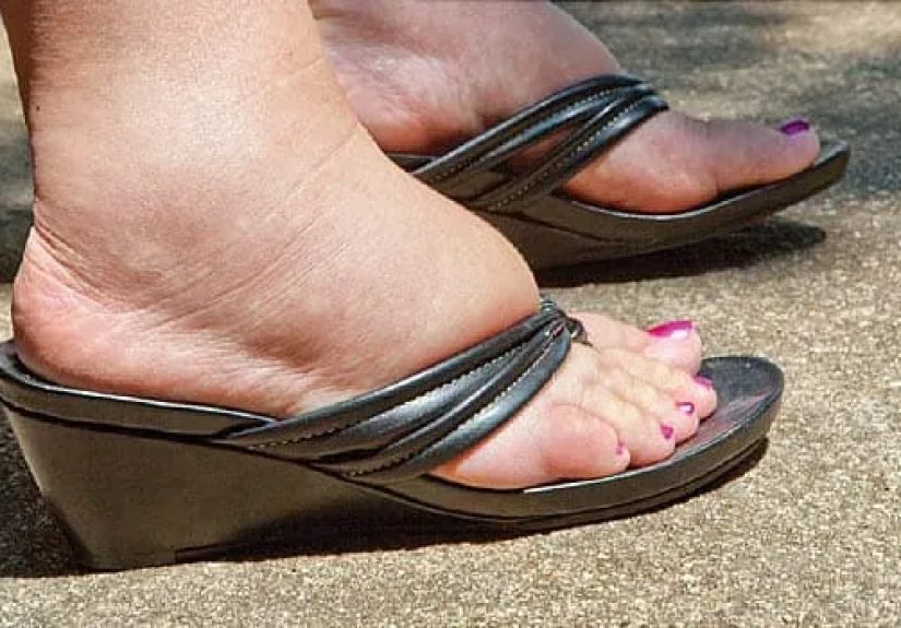 Swelling Causes and Treatment
