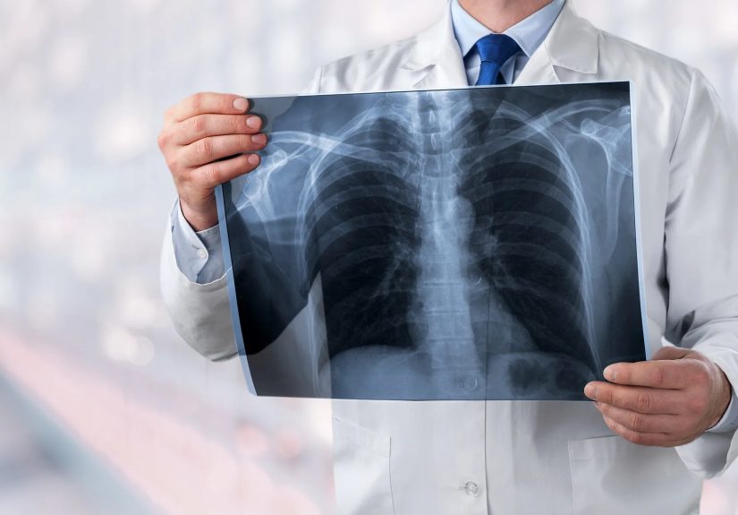 What Is a Lobectomy?