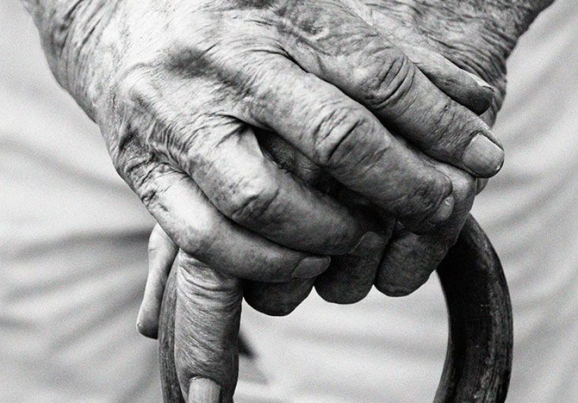 Gout: Complications and long-term management