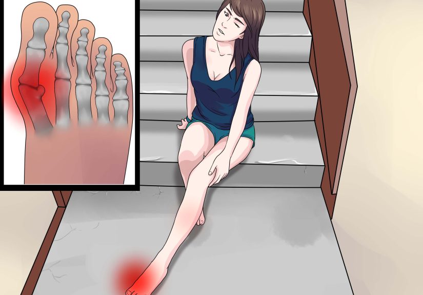 How to Know if You Have Corns: 9 Steps