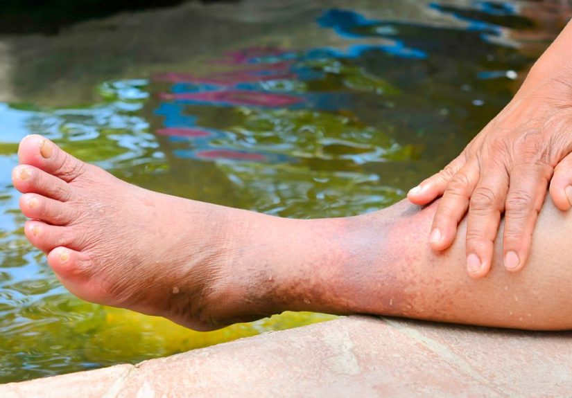 Varicose Eczema: Symptoms, Diagnosis, Treatment, and More