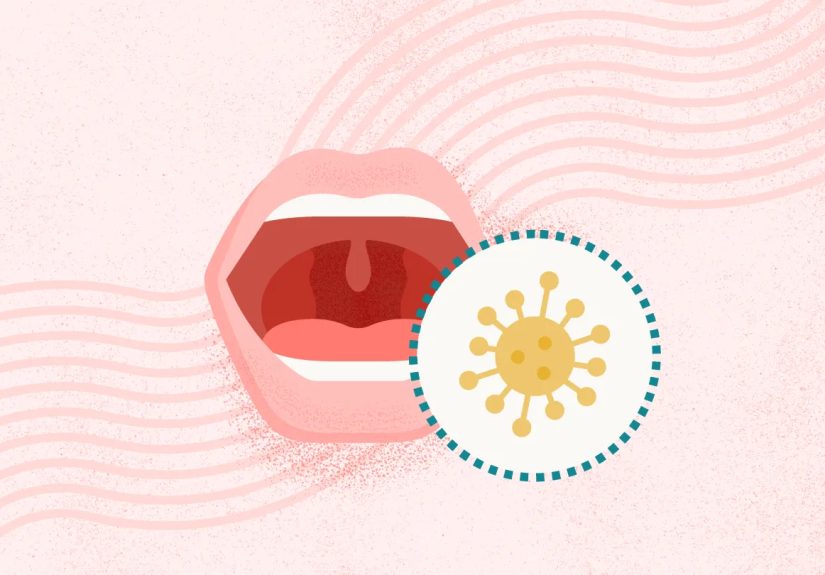 What Is Mononucleosis? Symptoms, Causes, Diagnosis, Treatment, and Prevention