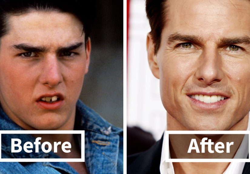 Before & After Transformations Of People Who Wore Braces