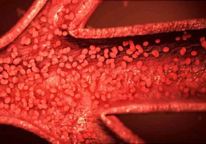 Blood Cancer Video on Polycythemia Vera