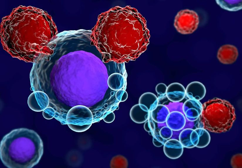 CAR T-Cell Therapy for Diffuse Large B-Cell Lymphoma