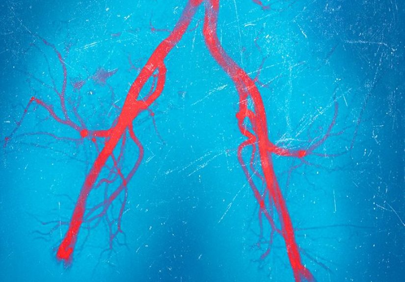 Coronary artery spasm: Definition, symptoms, and causes