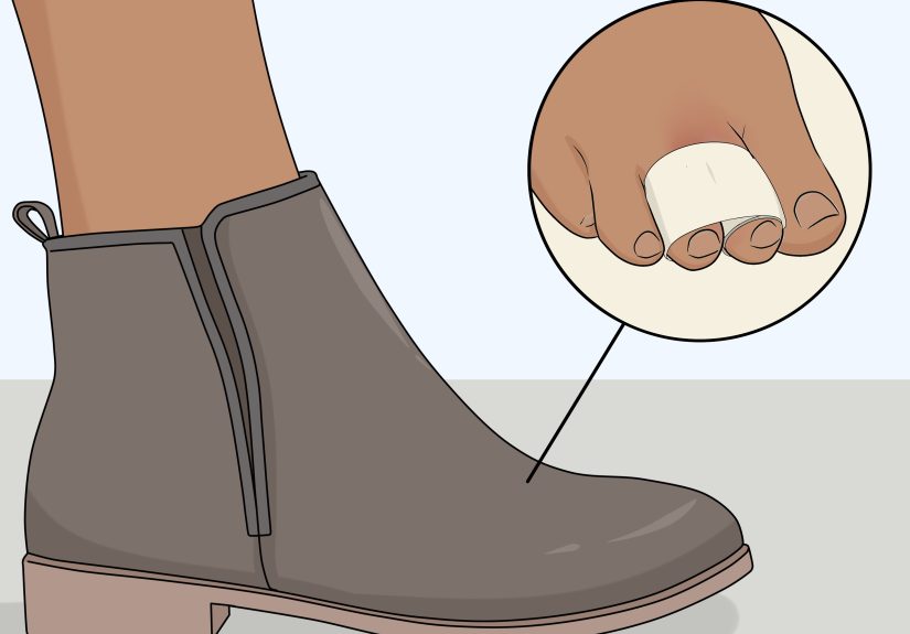 How to Buddy Tape an Injured Toe: 7 Steps
