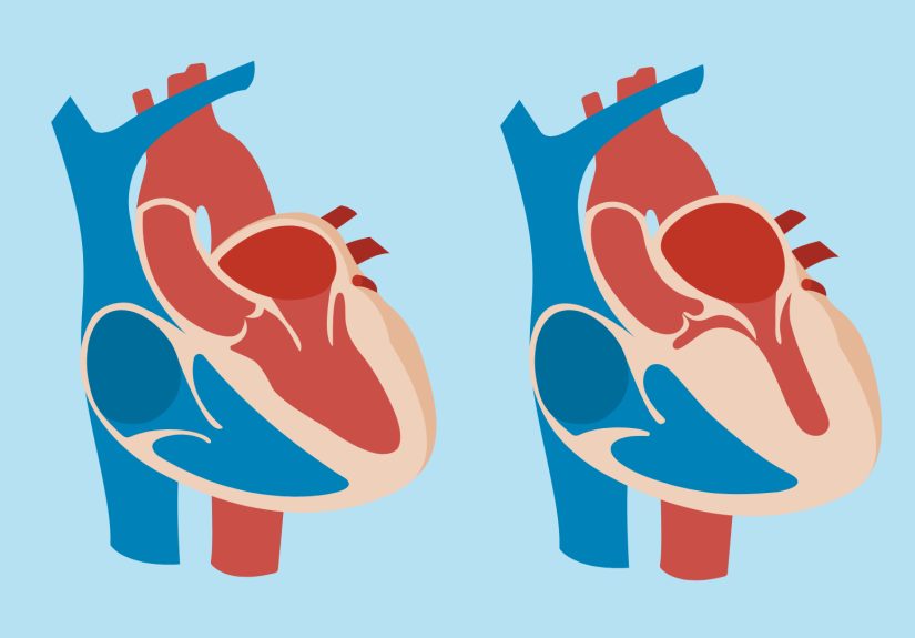 Hypertrophic Cardiomyopathy (HCM): Symptoms, Causes, Diagnosis, Treatment, and Prevention