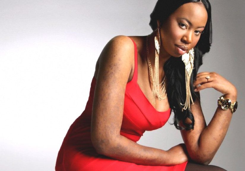 Refusing to Let Psoriasis Get in the Way of Love