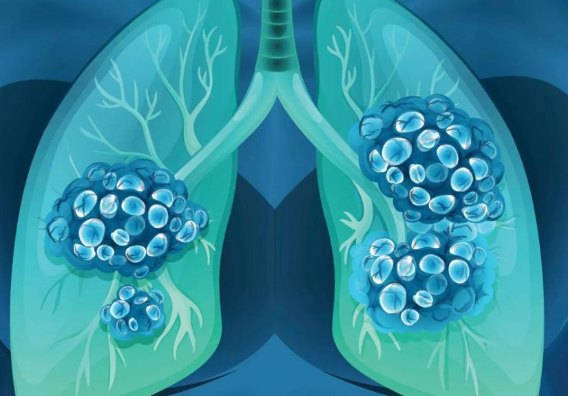 What Are the Chances a Lung Nodule or Spot Is Cancer?