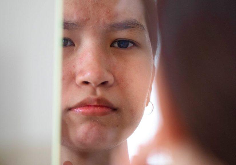 Angioedema Lips: What It Looks Like, Causes, and More