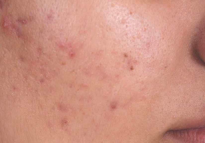Boil vs. Pimple: Tips for Identification
