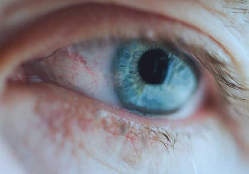 Episcleritis: Symptoms, Causes, and Treatment
