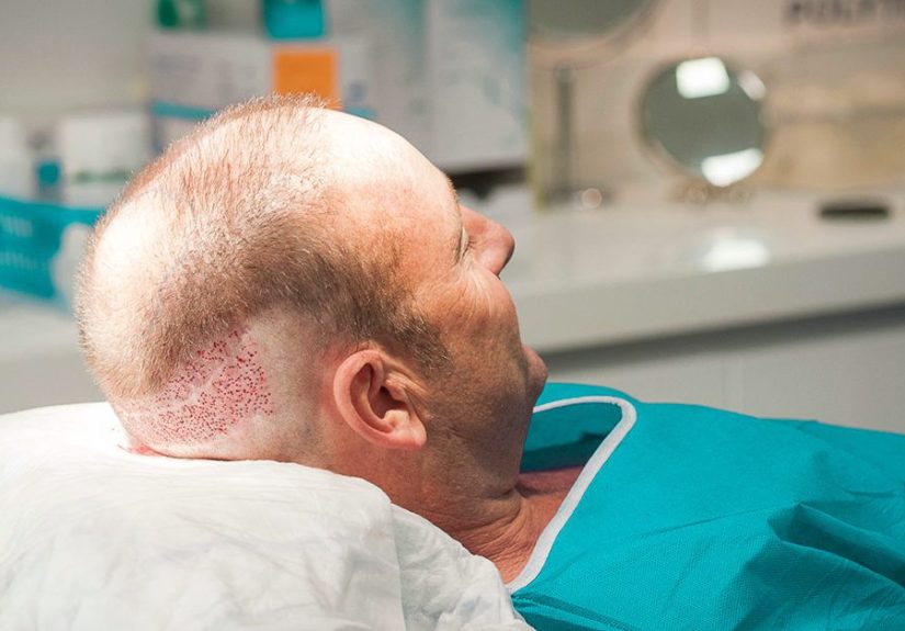 Hair Transplant on Scar: Yes It Works, Here's How