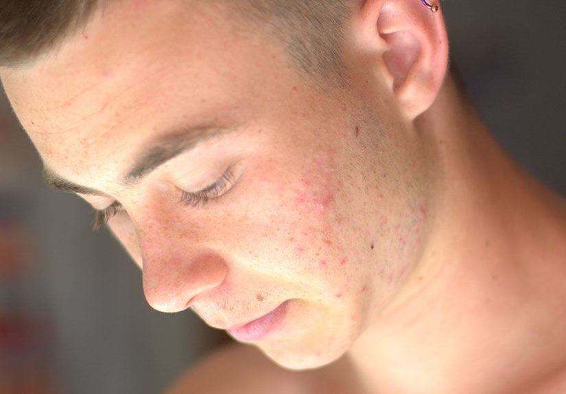 Retin-A for Acne: Uses, Side Effects, and More