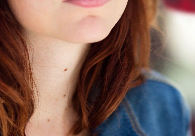 What Are Skin Moles? Types, Causes, and More